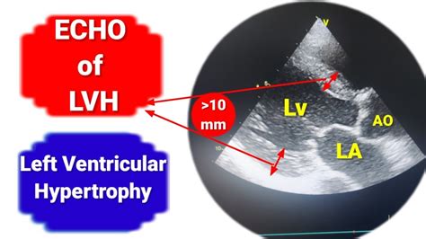 mild lvh means|mild lvh on echo.